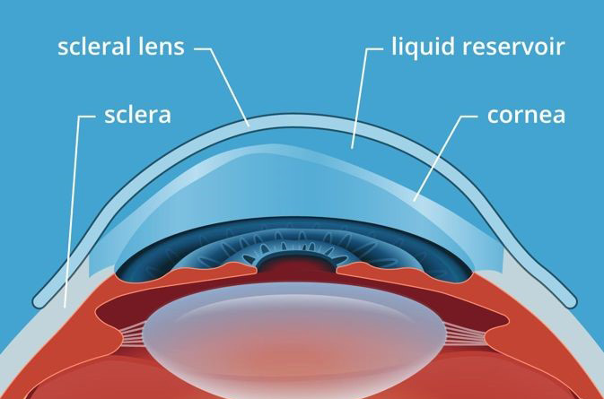 Scleral Lens Experts